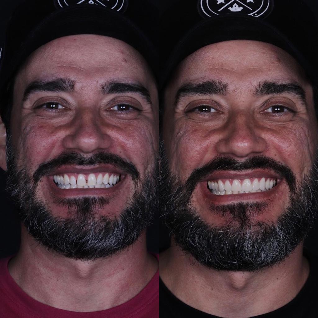 Caso real de reabilitação: antes e depois do tratamento