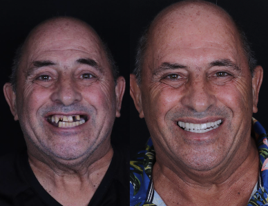 Caso real de reabilitação: antes e depois do tratamento