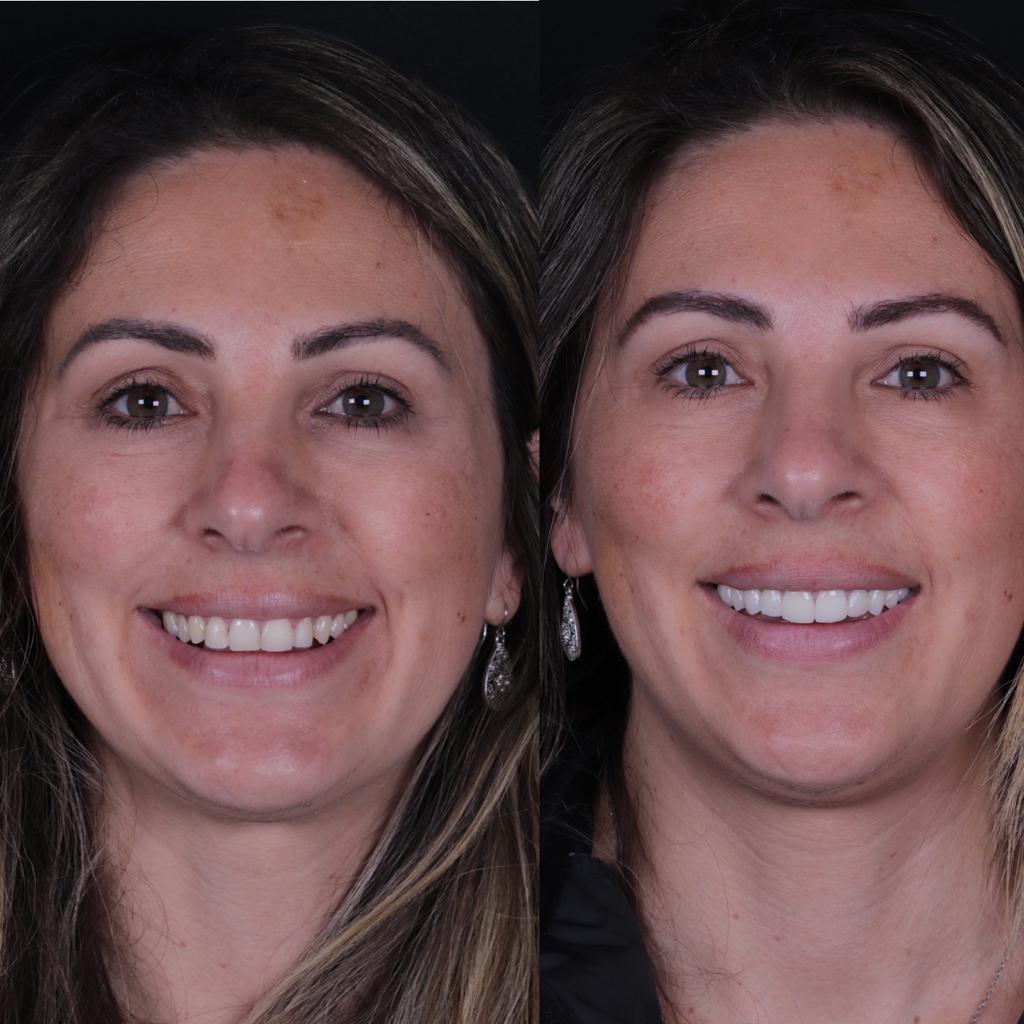 Caso real de reabilitação: antes e depois do tratamento