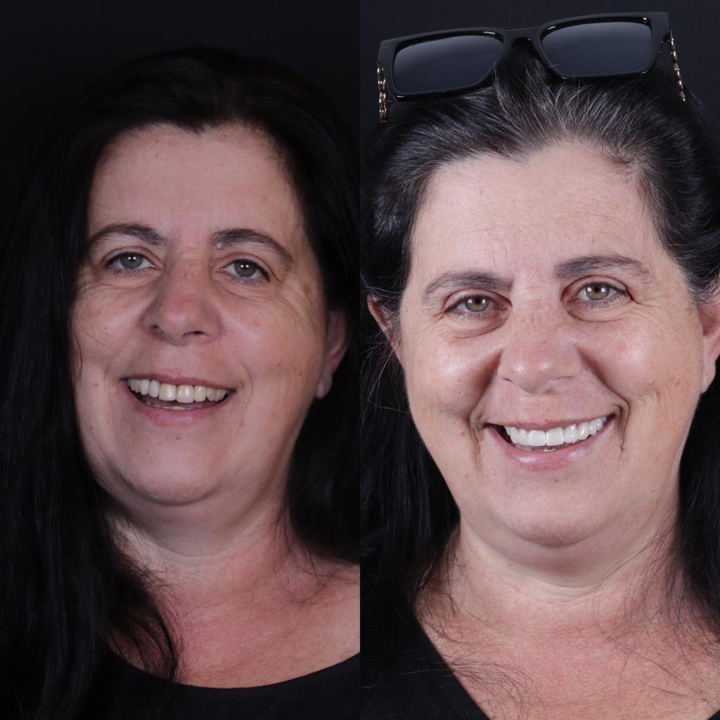 Caso real de reabilitação: antes e depois do tratamento